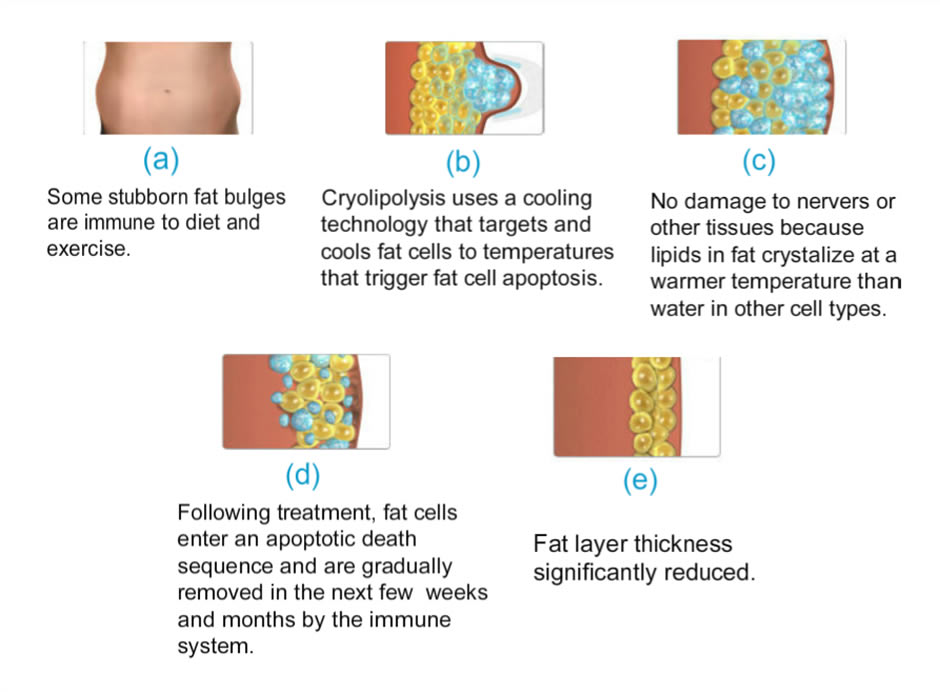 Cryolipolysis